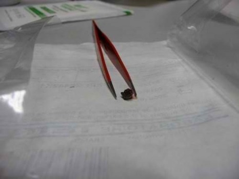 Eclat de bombe assourdissante retiré d'une blessure Eclat de bombe assourdissante retiré d'une blessure