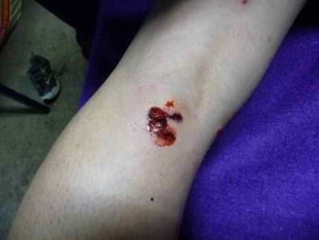 Brutalités et violence de l’Etat PS-Verts à Notre Dame des Landes : un médecin témoigne. Brutalités et violence de l’Etat PS-Verts à Notre Dame des Landes : un médecin témoigne.