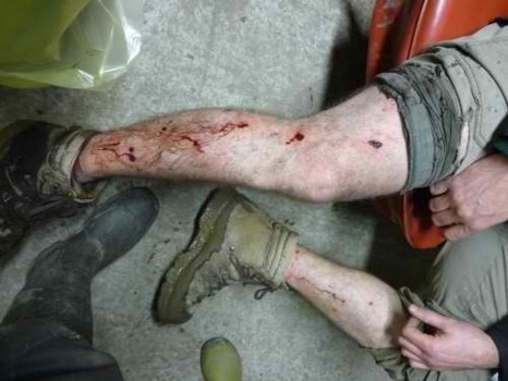 Brutalités et violence de l’Etat PS-Verts à Notre Dame des Landes : un médecin témoigne. Brutalités et violence de l’Etat PS-Verts à Notre Dame des Landes : un médecin témoigne.