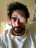 Quentin, gravement blessé à l'œil le 22 février à Nantes Quentin, gravement blessé à l'œil le 22 février à Nantes